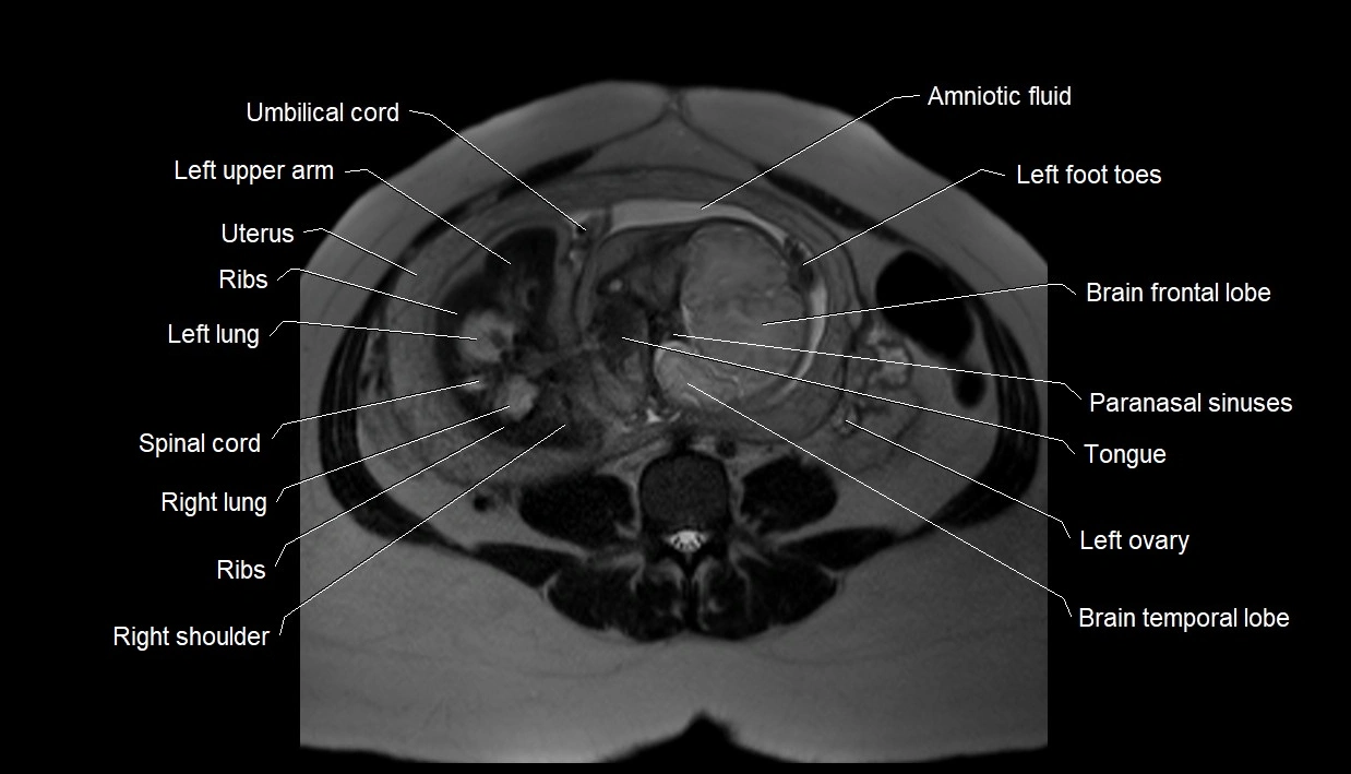 MRI fetal anatomy axial image 18.webp